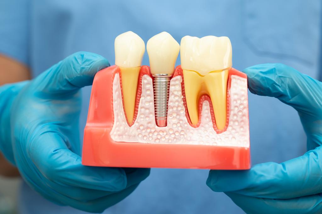 Dental implant, artificial tooth roots into jaw
