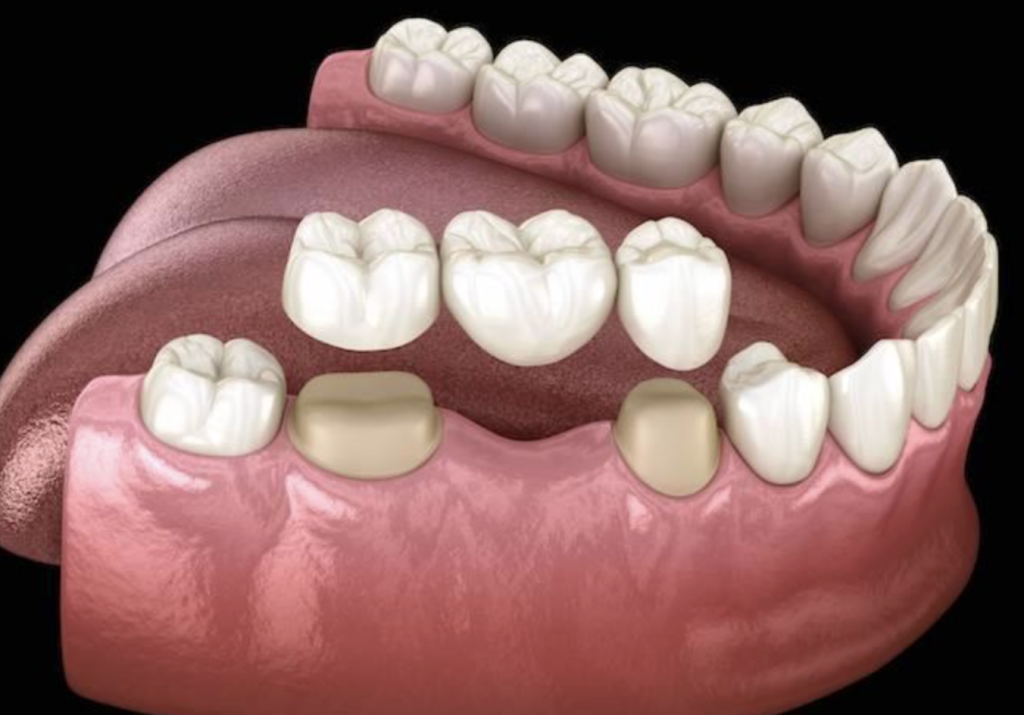 Bridges at Kamouni Dentistry