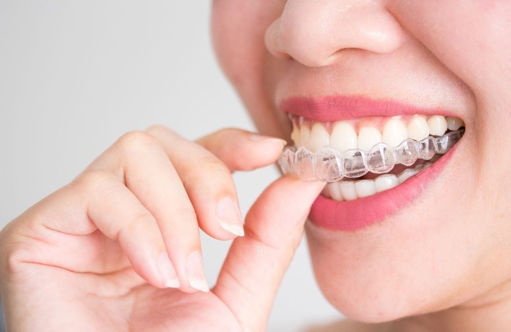 invisalign on a woman