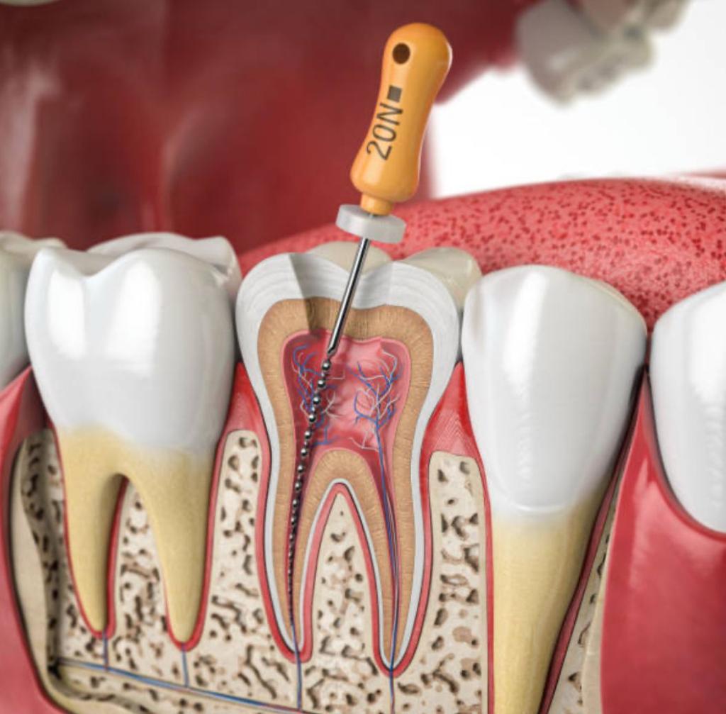 Endo at Kamouni Dentistry