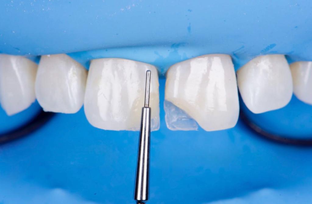 Composite Bonding